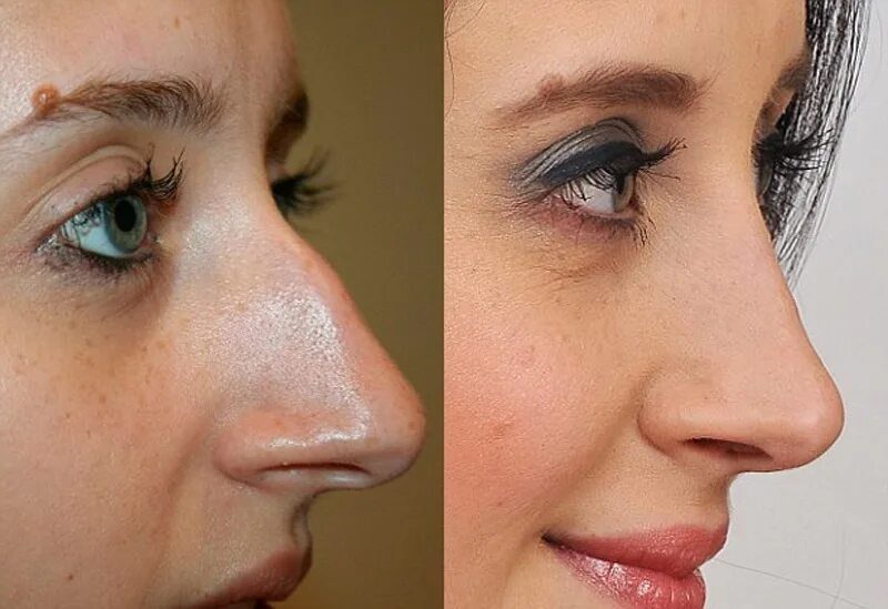 Нос после ковида. Ринопластика горбинки носа. Нос с горбинкой после ринопластики. Нос с горбинкой до и после операции. Нос картошкой с горбинкой.