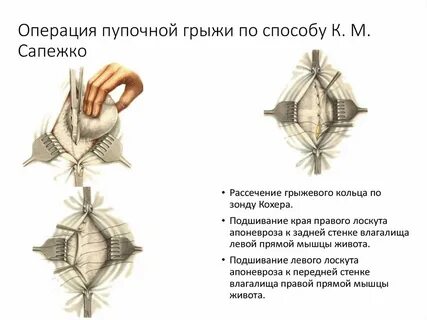 Пупочная грыжа методы операции