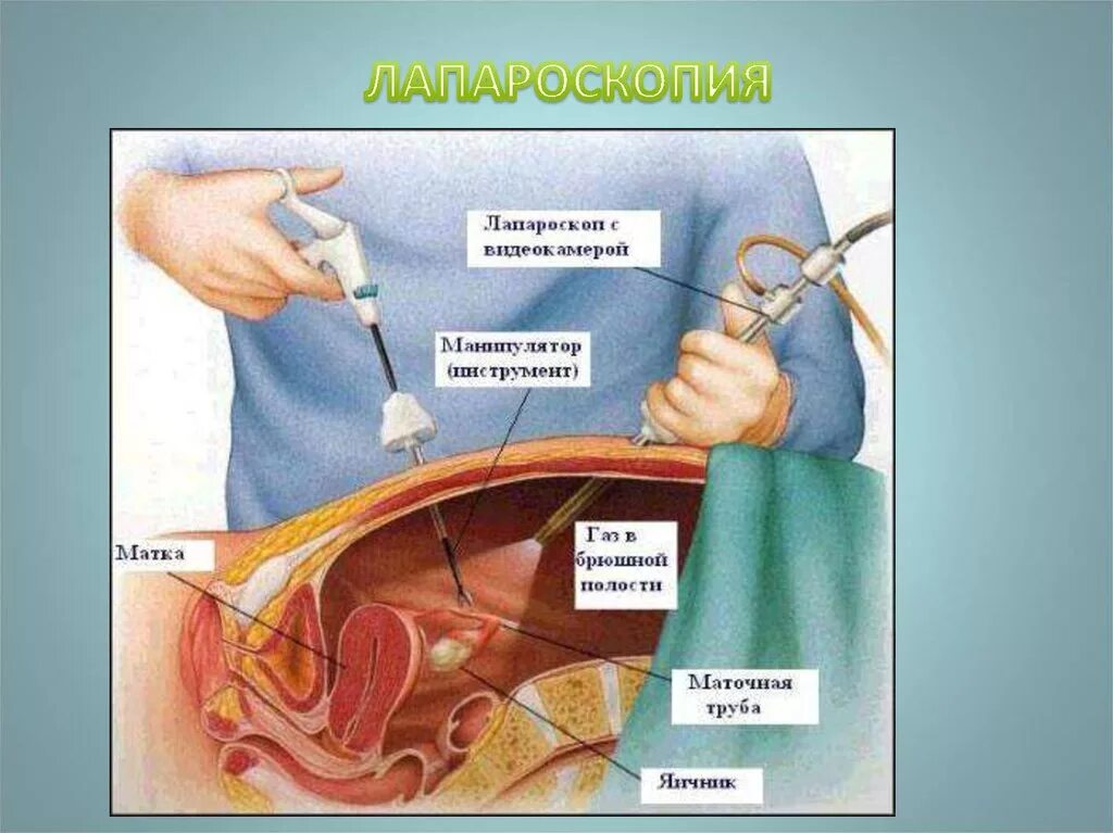 Лапароскопия экстирпация матки. Лапароскопия в гинекологии яичников. Лапароскопия маточных труб. Лапароскопическая операция перевязка маточных труб. Операция женских матка
