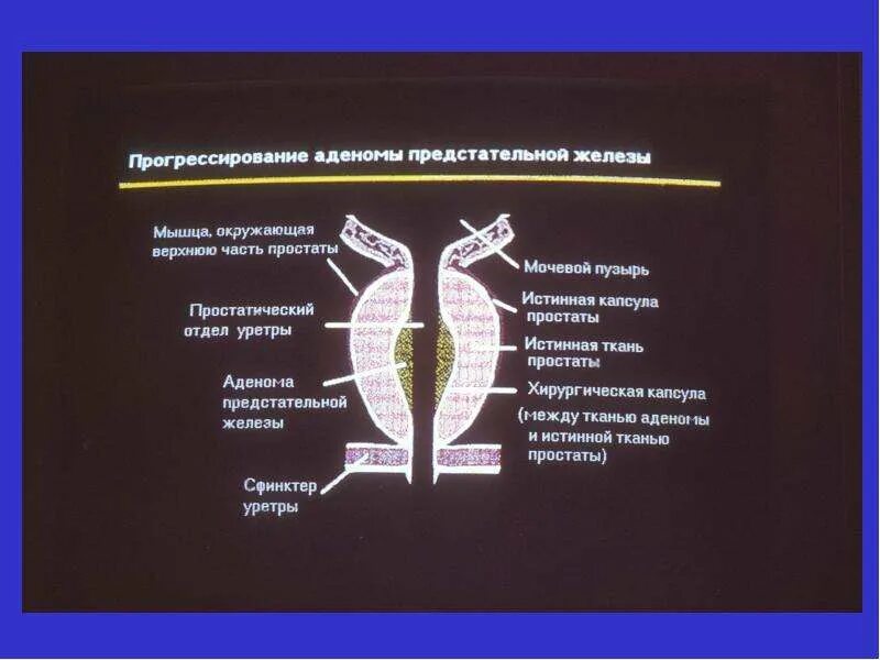 Сколько длится простата. Капсула предстательной железы. Хирургическая капсула простаты. Хирургическая и анатомическая капсула предстательной железы. Анатомия аденомы предстательной железы.