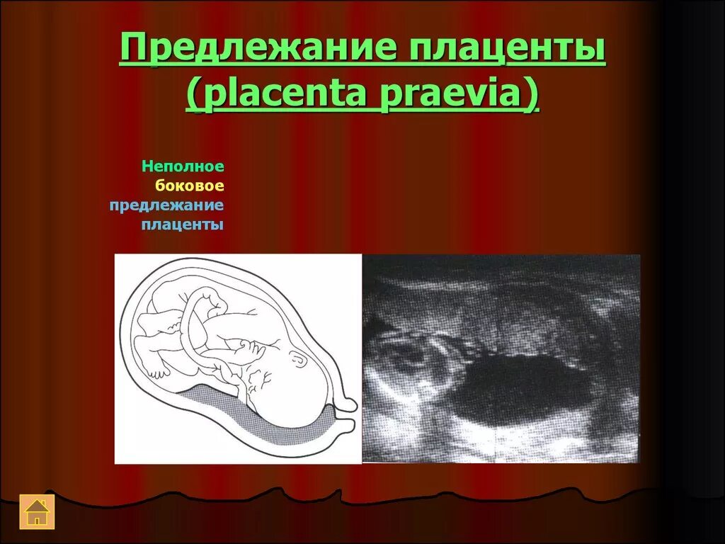 Полное предлежание форум. Предлежание плаценты на УЗИ. Неполное предлежание плаценты. Низкая плацента по УЗИ. Низкое расположение плаценты УЗИ.