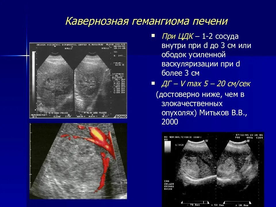 УЗИ картина кавернозной гемангиомы печени. Кавернозная гемангиома печени на УЗИ. Капиллярная гемангиома печени на УЗИ. Капиллярно кавернозная гемангиома. Очаговые гемангиомы печени