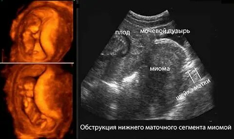 Можно родить без матки. Можно родить без матки
