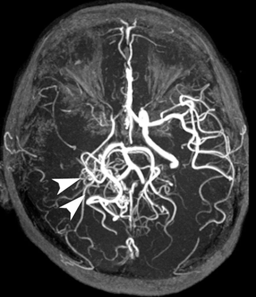 Мрт с контрастом головного. Магнитно-резонансная ангиография артерий головного мозга. Мрт ангиограмма сосудов головного мозга. МРА (магнитно-резонансная ангиография). Мрт венография сосудов головного мозга.