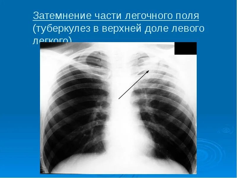Очаги с нечеткими контурами в легком. Затемнение средней интенсивности с нечеткими контурами. Затемнение правого легкого что это. Перибронхиальная инфильтрация рентген. Затемнение на рентгене легких.