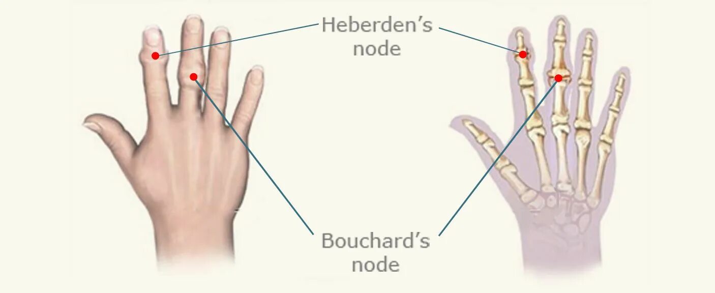 Heberden and Bouchard nodes Bones, X ray, Human hand