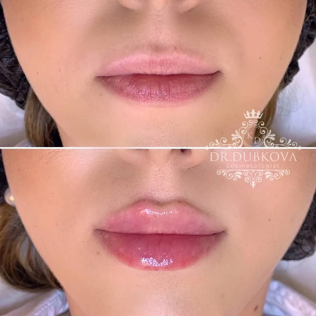 Форма губ бант. Контуринг губ гиалуроновой кислотой. формы губ для увеличения гиалуроновой. формы губ для увеличения гиалуроновой кислотой. форма губ бантиком.