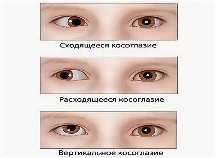 Операция по исправлению косоглазия у детей. Сходящееся косоглазие. косоглазие у детей. косоглазие схема. левостороннее сходящееся косоглазие.