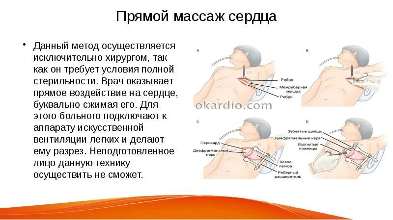 Хамиль остановка сердца. Прямой массаж сердца методика. Открытый массаж сердца техника. Прямой массаж сердца техника. Как делать прямой массаж сердца.