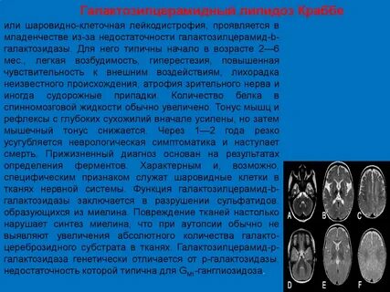 Болезнь краббе простыми словами