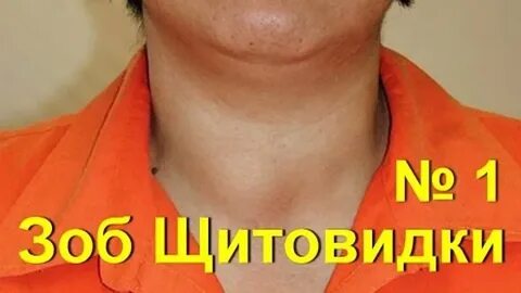 Многоузловой зоб щитовидной