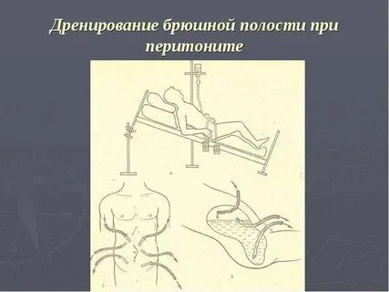 Дренирование брюшной полости