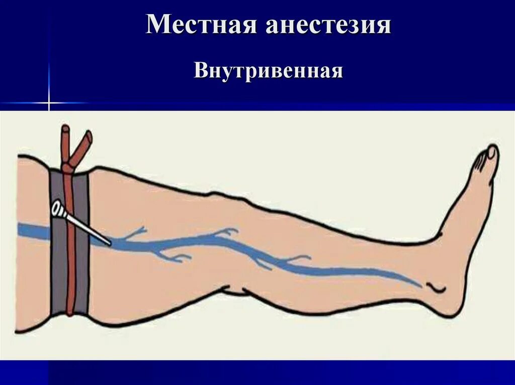 Внутрикостная блокада. Внутривенная местная анестезия. Внутрисосудистая местная анестезия. Внувтри венная анестезия. Внутривенная и внутрикостная анестезия.