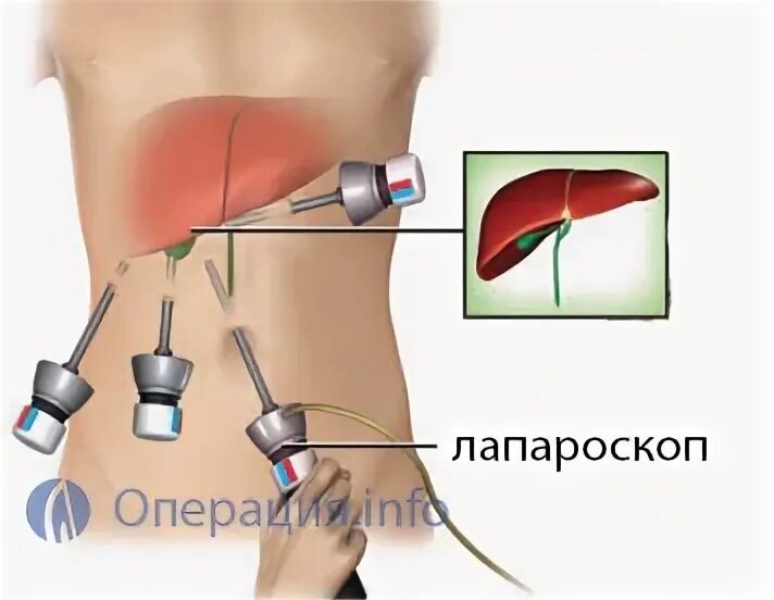 Как долго после удаления желчного пузыря. Биопсия желчного пузыря. лапароскопия с биопсией печени. операция на желчный пузырь. удаление желчного пузыря лапароскопия.