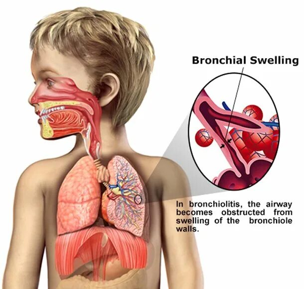 У ребенка легкий бронхит