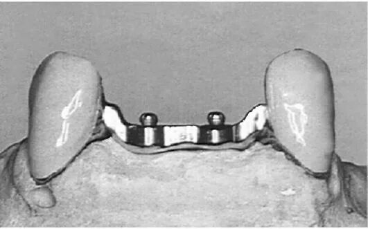 балочная система фиксации бюгельных протезов