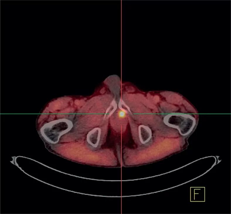 ПЭТ кт предстательной железы. ПЭТ кт с холином предстательной железы. Рецидив предстательной железы