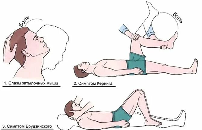 Ригидность затылочных мышц, симптомы Брудзинского, Кернига. Ригидность затылочных мышц и симптом Кернига. Симптом Кернига Брудзинского Бехтерева. Симптомы менингита Кернига Брудзинского.
