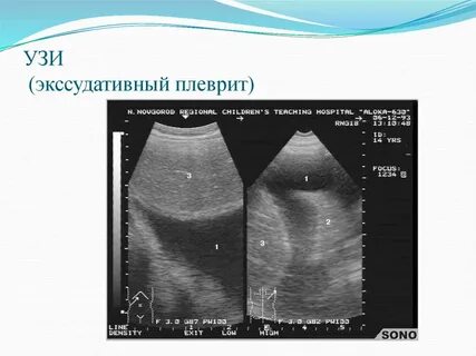 Задача с плевритом
