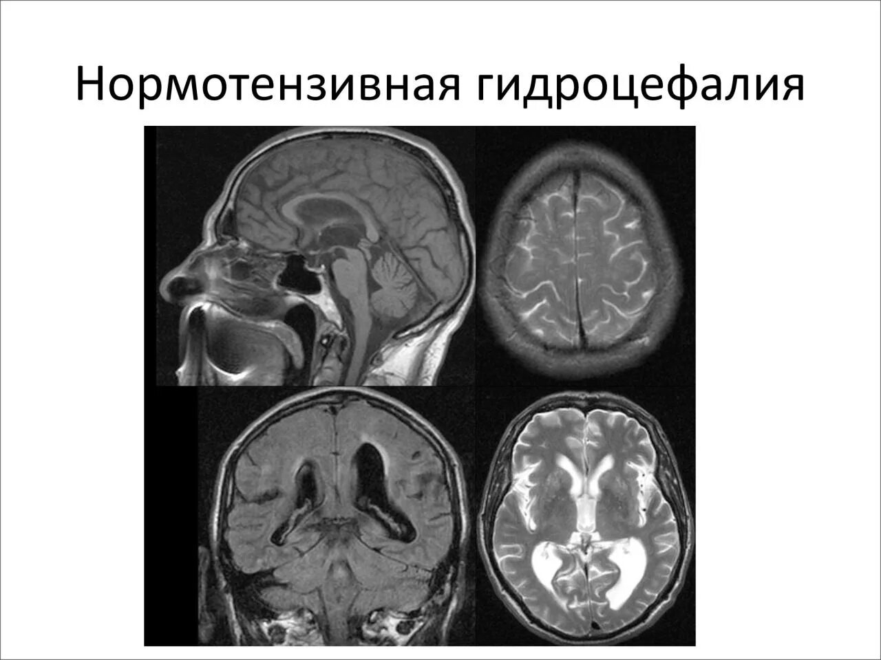 Как лечить гидроцефалию мозга. Гидроцефалия головного мозга мрт. Нормотензивная гидроцефалия мрт критерии. Заместительная гидроцефалия кт. Мрт при нормотензивной гидроцефалии.