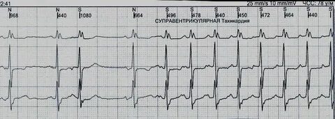 Тахикардия 120