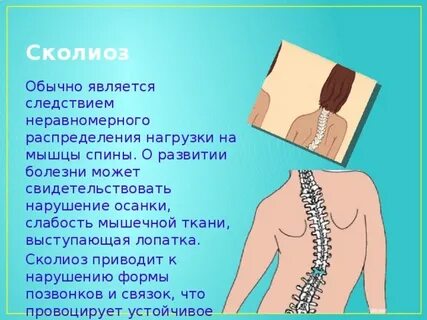 Сколиоз код