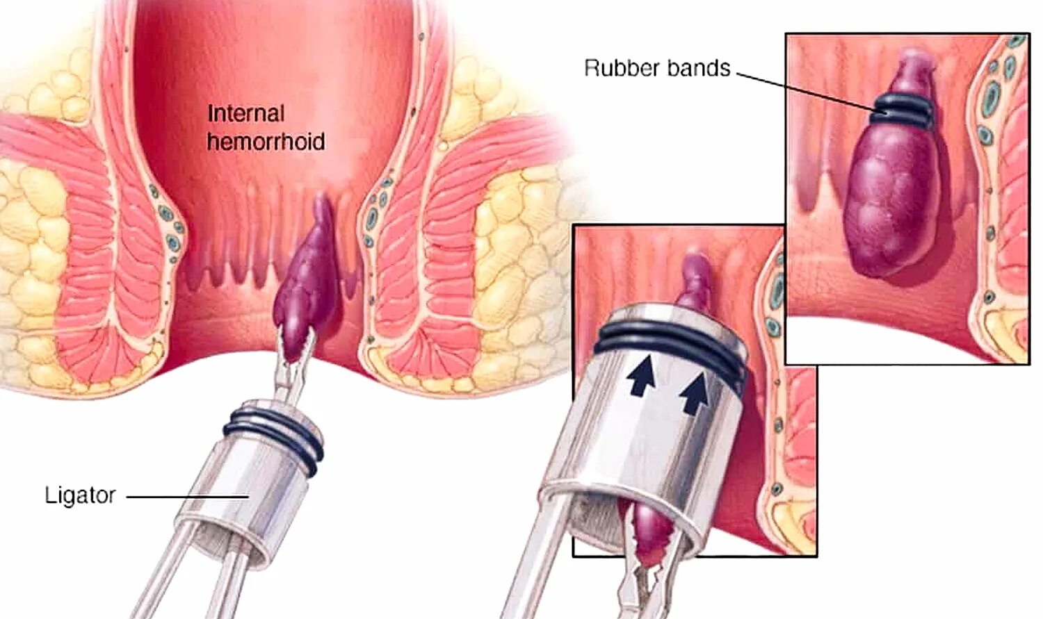 После лигирование геморроидальных узлов. Лигирование узлов латексными кольцами. Легирование геморроидальных узлов.