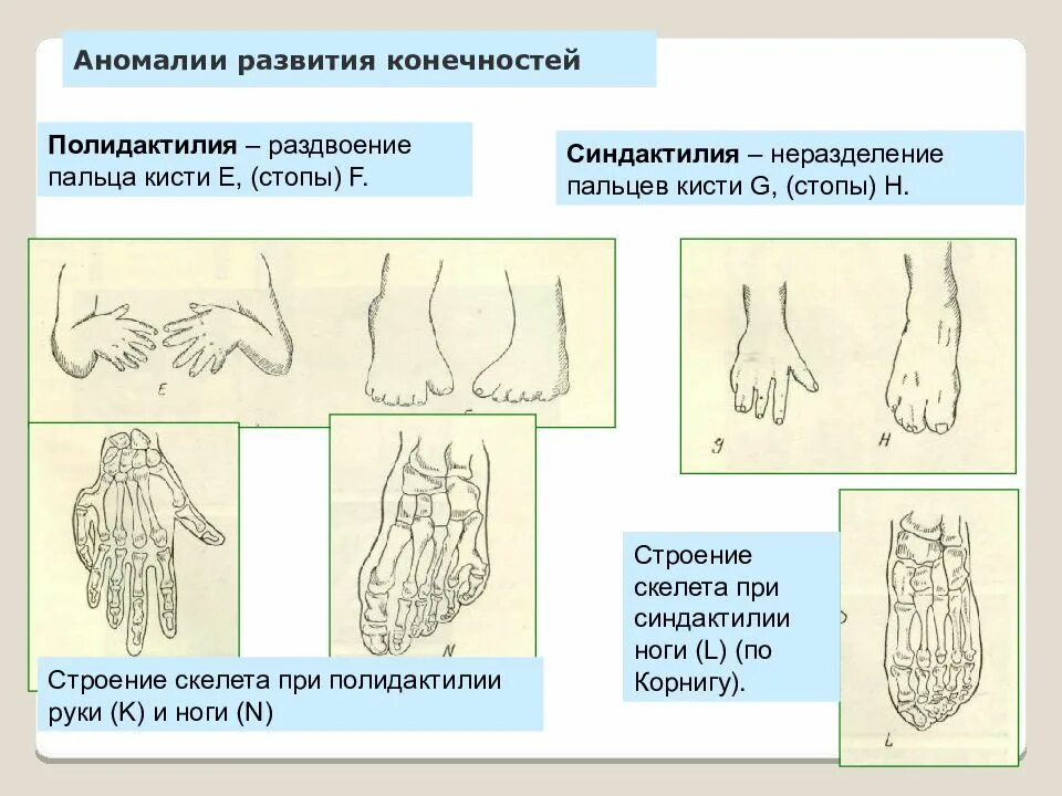 Развитие нижней конечности. Аномалия развития нижних конечностей. Врожденные пороки развития скелета. Пороки развития конечностей.