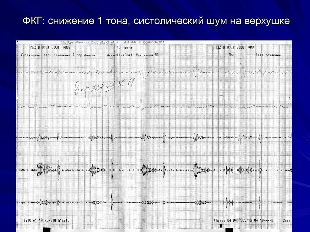 Графическое изображение фкг. Фкг 1 тон. фонокардиограмма при ослаблении 1 тона. графическое изображение фкг при ослаблении 1 тона. фкг.