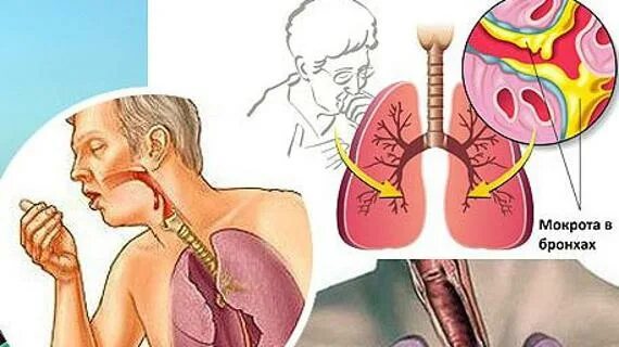 Мокрота и свисты. Заболевания трахеи и бронхов.