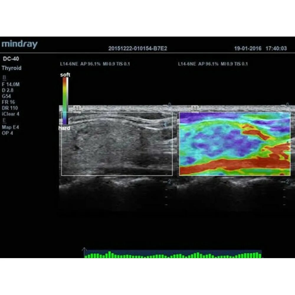 Узи отзывы спб. УЗИ аппарат Mindray DC-45. Эластография печени методом сдвиговой волны. Эластография поверхностных структур. Нормы для эластографии миндрэй.