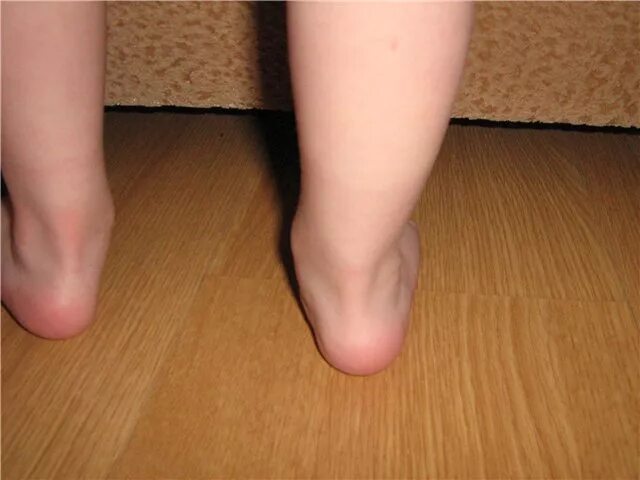 Плоскостопие вальгусная стопа. Вальгус стопы у ребенка 7 лет. Вальгусная деформация стопы у ребенка 7 лет.