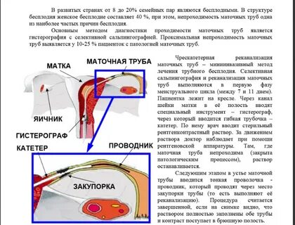 Можно ли развязать трубы и забеременеть