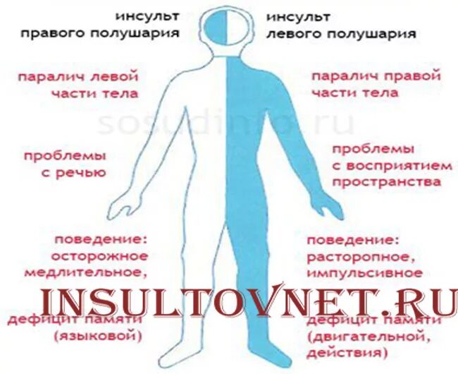 Парализовало после инсульта прогноз. Осложнения инсульта гемипарез. Правосторонний инсульт. Инсульт левосторонний гемипарез. Паралич после инсульта.