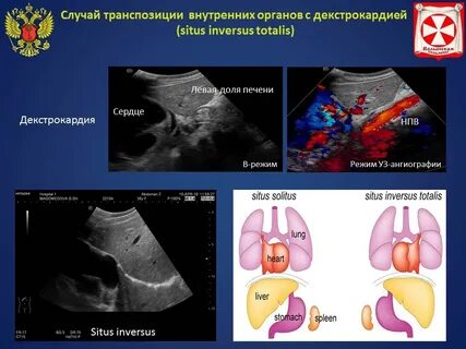 Транспозиция внутренних