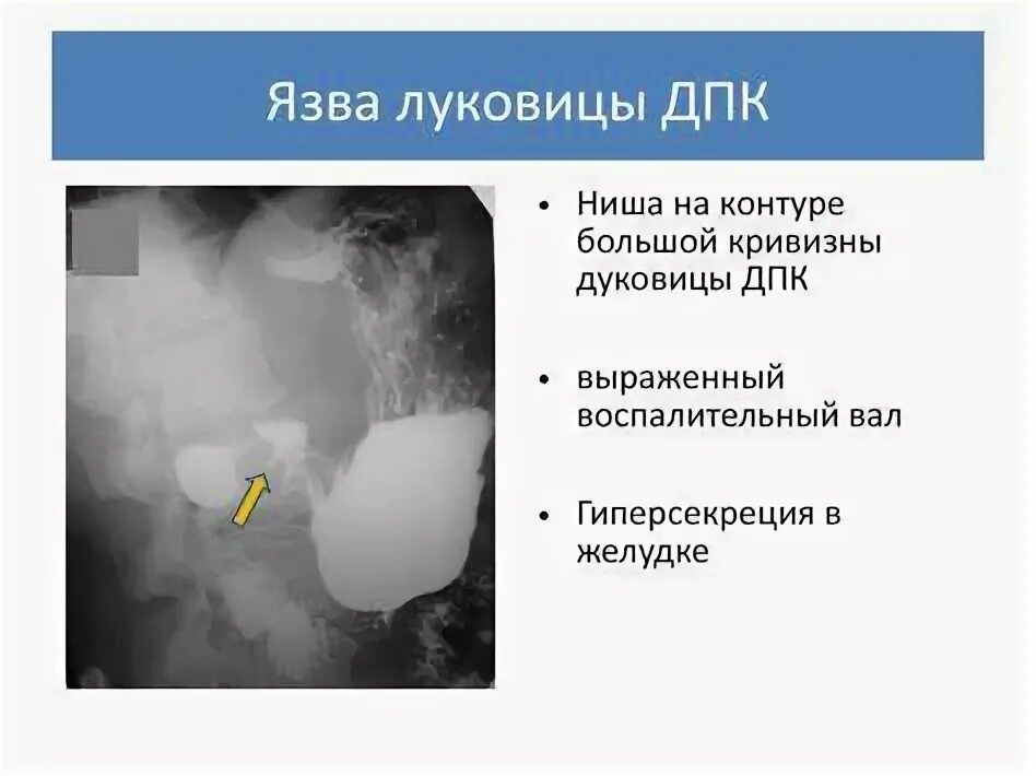 Умеренная деформация луковицы. Умеренная деформация луковицы