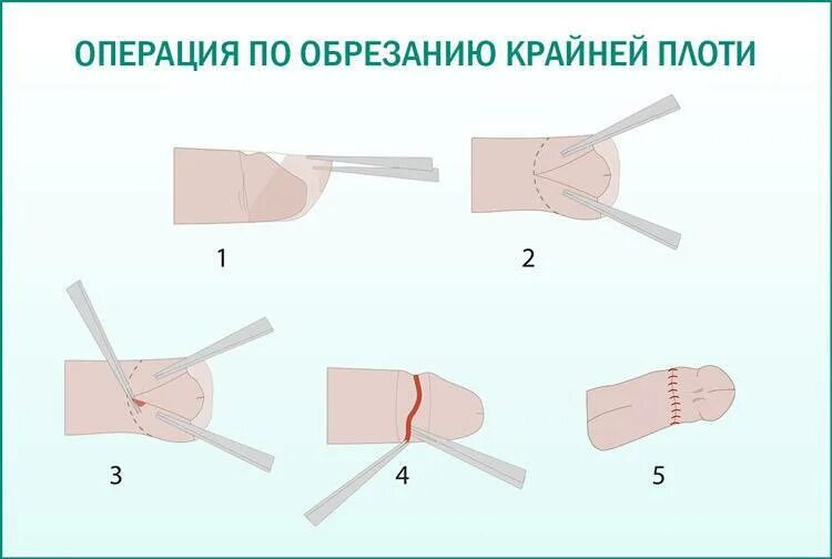 Сделать обрезание крайней. Циркумцизио (обрезание крайней плоти) (схема 2). циркумцизия ход операции. обрезание у мужчин схема.