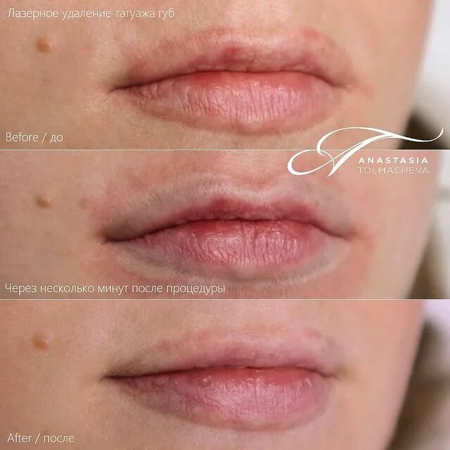 Губы после резекции. Перманентный макияж губ. Губы после резекции. Губы после перманентного макияжа. Губы после резекции.