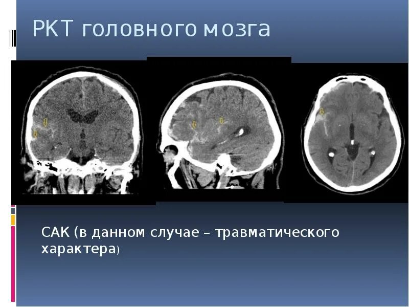 Что такое ркт. РКТ головного мозга. РКТ снимок головного мозга. РКТ головы. Рентгеновская компьютерная томография.