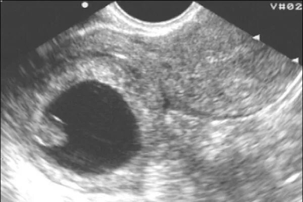 Внематочная беременность в рудиментарном Роге на УЗИ. Внематочная Трубная беременность УЗИ. Внематочная беременность в рудиментарном Роге. Беременность УЗИ на внематочную беременность. На узи видно внематочную