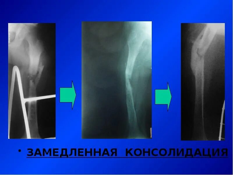 Что такое консолидация перелома. Замедленная консолидация переломов и ложные суставы. Стадии консолидации перелома на рентгене. Замедленная консолидация переломов рентген. Замедленная консолидация и ложный сустав.