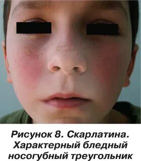 Температура горло сыпь красная