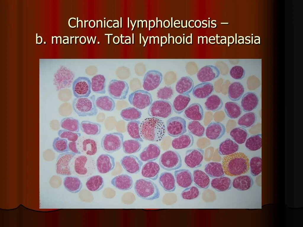 B хронический лимфолейкоз. Острый лейкоз и хронический лимфолейкоз. Хронический лимфоцитарный лейкоз картина крови. Клетки Боткина Гумпрехта это. Костный мозг хронического лимфолейкоза.
