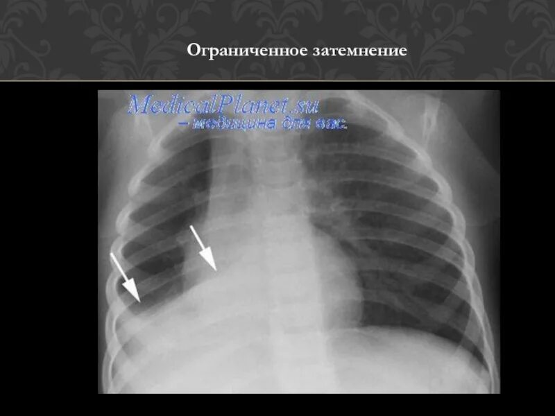 Как ты понимаешь что такое затемнение. Ограниченное затемнение легких. обширное затемнение легочного поля. ограниченное затемнение рентген. обширное затемнение на рентгенограмме.