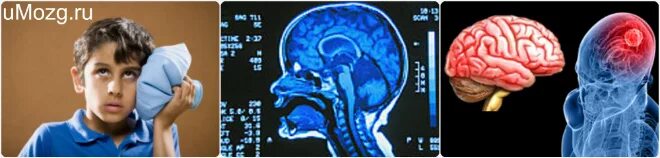 3 сотрясения мозга. Снимок головного мозга при сотрясении. Сотрясение головного мозга симптомы.