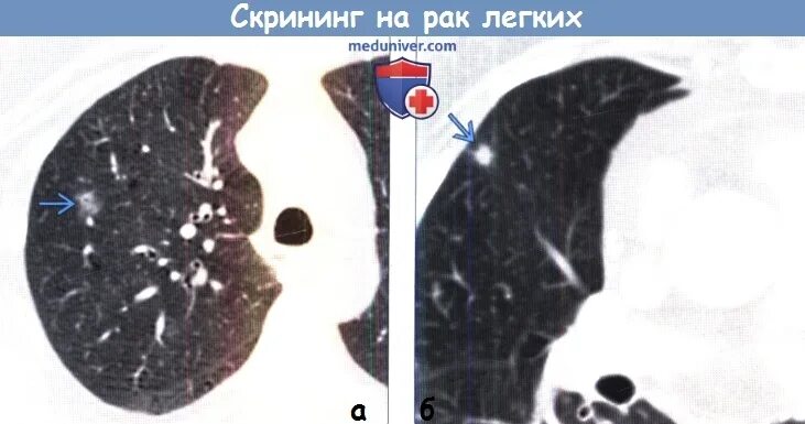 Скрининг рака легкого. Скрининг легких. Гамартома легких на кт.