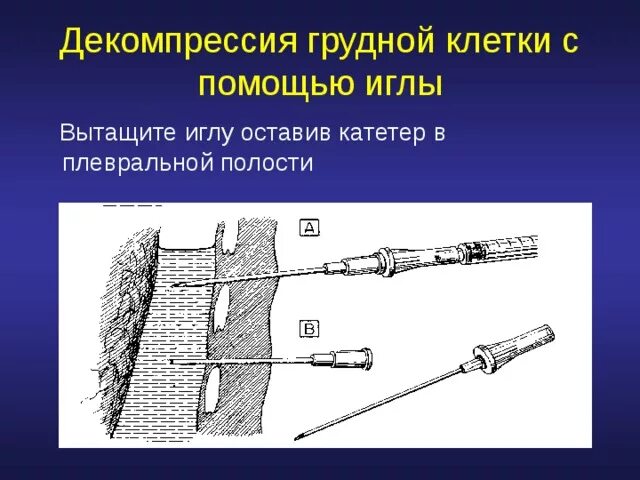 Шприц для пункции плевральной полости. Пункция и дренирование плевральной полости. Игла плевральной полости. Игла для пункции плевральной полости.