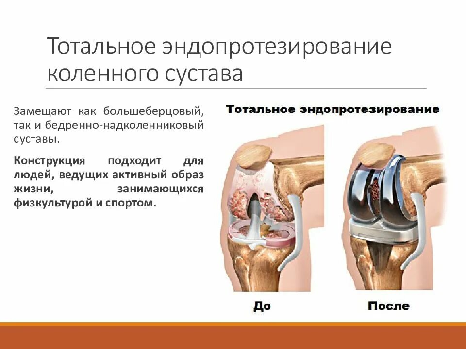 Тотальное эндопротезирование коленного сустава DEPUY. Тотальное эндопротезирование коленного сустава цементная фиксация. Тотальное эндопротезирование тазобедренного сустава. Эндопротезирование тазобедренного сустава тотальное (схема 2). Эндопротезирование отзывы после операции