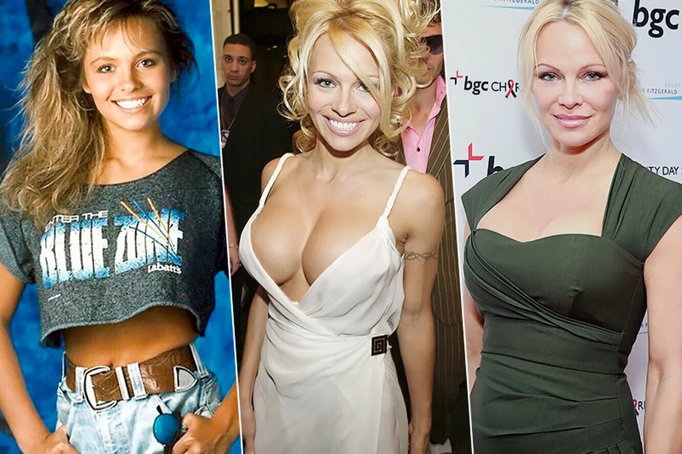 Якорная редукционная маммопластика. Неудачная маммопластика. Виктория бекхэм грудь до и после. Пола абдул грудь. Виктория бекхэм пластика груди.