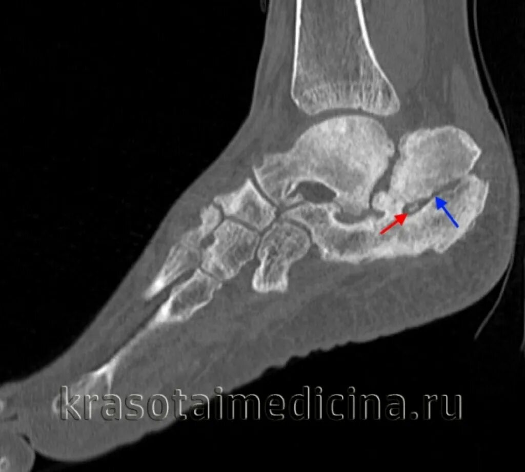 Остеомиелит таранной кости кт. Остеомиелит пяточной кости кт.